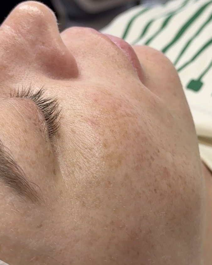 Antes del peeling químico: primer plano de la mejilla
