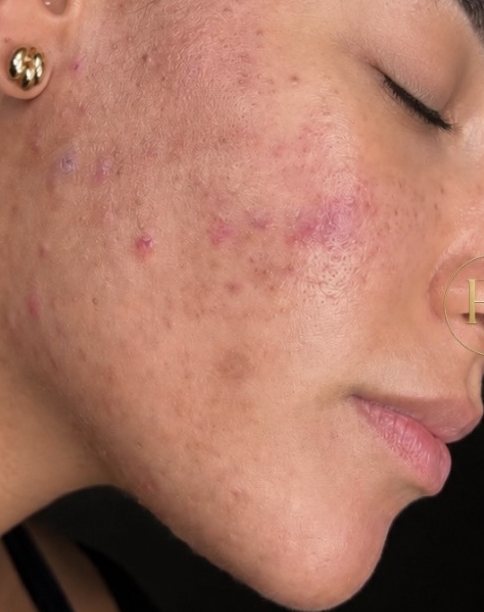 Antes del tratamiento Meso-Peeling: mejilla con acné activo y marcas