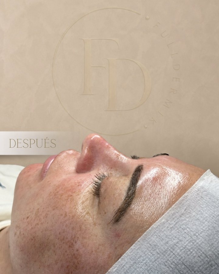 Después del peeling químico: piel luminosa y textura más uniforme