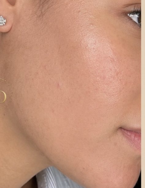 Después del tratamiento Meso-Peeling: mejilla con la piel más uniforme y menos lesiones de acné